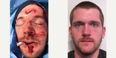 25-34 year old man treated with Facial Reconstructive Surgery - 25 year old male received facial reconstructive surgery for an injury; photos depict the patient's results 1 year post-op.