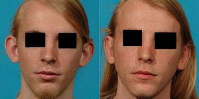 18-24 year old man treated with Ear Surgery - Young man bothered by his protruding ears, about to start college decided to consult with Dr. Olson who recommended an otoplasty procedure that was performed in an office setting under local anesthetic.