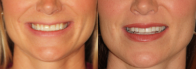 35-44 year old woman treated with Lip Lift - A Lip Lift is a surgical procedure to shorten the space between the nose and the top lip, to give the appearance of a fuller top lip and the show more teeth when you smile.