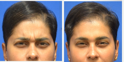 35-44 year old woman treated with Daxxify - Improved frown lines/ glabella, forehead, and crowsfeetInjected by Scarlet PA-C