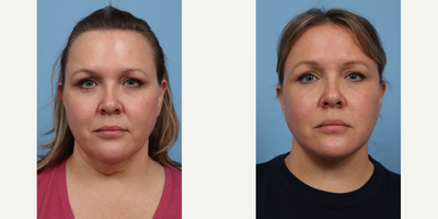 45-54 year old woman treated with Facelift - 6 weeks post deep plane facelift