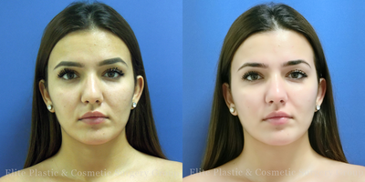 Glutathione + Vitamin C Skin Brightening IV Push - Patient underwent 4 sessions - Patient had 4 sessions of Glutathione + Vit C Skin Brightening IV Push combined with 4 sessions of Skin Brightening Facials