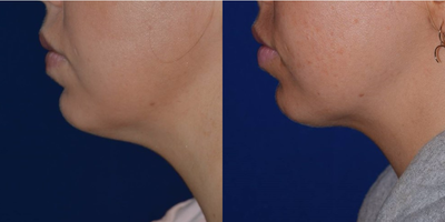 25-34 year old woman treated with Lipodissolve - Before and after Kybella injection for double chin.