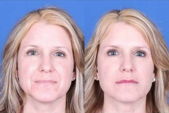 45-54 year old woman treated with Voluma - Juvederm to nasolabial folds, Voluma to cheeks