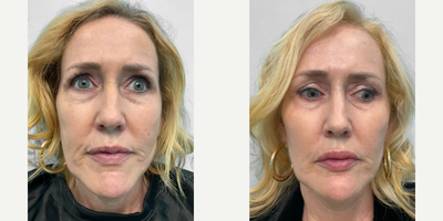 45-54 year old woman treated with Lip Fillers, Dermal Fillers, Chin Filler - This woman in her mid-fifties had lost volume in her cheeks after losing weight and was interested in rejuvenating her mid face.  Our nurse injector Heather treated her with filler to her lips, marionette lines, cheeks, chin, and temples and she looks great.