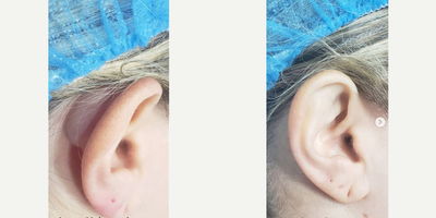 Woman treated with Cyst Removal - Surgical removal of an encapsulated congenital hemangioma. Patient has had this tumor for more than 20 years. It was previously treated as a cyst with multiple attempts to drain the cyst. The lesion grew over time and caused ear deformity, pain and discomfort.