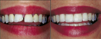 Repaired and replaced old broken dental crowns - 
	Repaired and replaced old broken dental crowns
