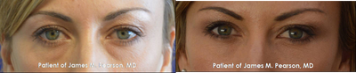 Lower Eyelid Rejuvenation (Tear Trough / Under Eye Hollows) - 
	Lower Eyelid Rejuvenation (Tear Trough / Under Eye Hollows)

