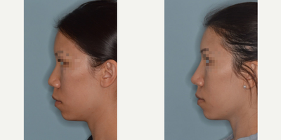 18-24 year old woman treated with Asian Rhinoplasty - Asian female patient who desired to have refinements to her tip and bridge. The bridge was refined by narrowing and raising the bridge of her nose. Bridge refinement was achieved with osteotomies and augmentation using temporalis fascia and diced cartilage grafting. The tip was narrowed and refined using a tip graft.