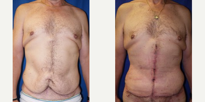 45-54 year old man treated with Panniculectomy - 45-54 year old man treated with Panniculectomy