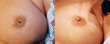 23 year old female patient  - Patient had such severely inverted nipples it appeared there was no nipple bud whatsoever, one only sees the hole.