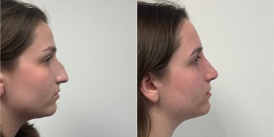 17 or under year old woman treated with Rhinoplasty - 3 Weeks after a Rhinoplasty