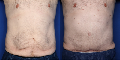 45-54 year old man treated with Male Tummy Tuck - 45 y/o male who is shown one year after a tummy tuck with liposuction. He had lost approximately 70 pounds prior to surgery.
