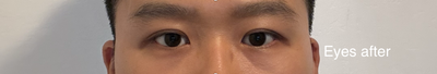 Eyes after (well, speaks for itself)