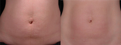 35-44 year old woman treated with Thermage - Before and after Thermage with fraxel for skin laxity and tone on the stomach.