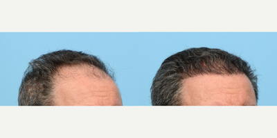 45-54 year old man treated with FUE Hair Transplant, Hair Transplant, Hair Loss Treatment, PRP for Hair Loss, Kybella - Dr. Wise performed an FUE hair transplant on this patient to rebuild his hairline, add overall density, and fill in his crown. During the procedure he used 3,550 grafts and one treatment of PRP.