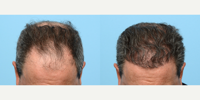 45-54 year old man treated with FUE Hair Transplant, Hair Transplant, Hair Loss Treatment, PRP for Hair Loss, Kybella - Dr. Wise performed an FUE hair transplant on this patient to rebuild his hairline, add overall density, and fill in his crown. During the procedure he used 3,550 grafts and one treatment of PRP.