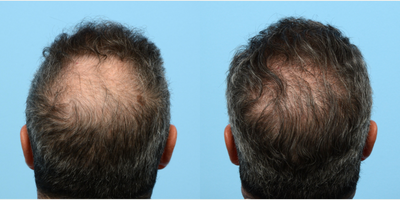 45-54 year old man treated with FUE Hair Transplant, Hair Transplant, Hair Loss Treatment, PRP for Hair Loss, Kybella - Dr. Wise performed an FUE hair transplant on this patient to rebuild his hairline, add overall density, and fill in his crown. During the procedure he used 3,550 grafts and one treatment of PRP.