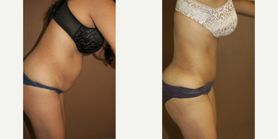 35-44 year old woman treated with Tummy Tuck - Abdominoplasty - Tummy Tuck