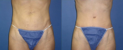 Tummy Tuck Revision - 	Patient did not do her research and had her tummy tuck performed by a dentist. I performed a revision tummy tuck and complete reconstruction of her navel.