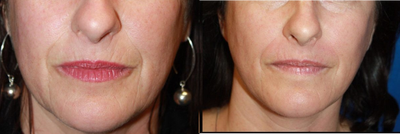 Woman treated with Collagen Injection - Woman treated with Collagen Injection