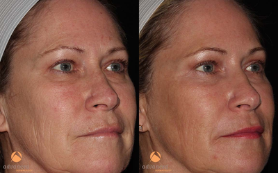 Female Patient Treated for Wrinkles and Texture with C02RE Fractional C02 Resurfacing Treatment - 	3 Months post CO2RE Fractional C02 Resurfacing Treatment