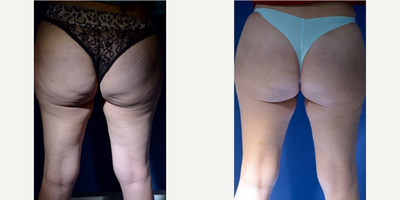 Woman treated with Cellfina - Woman treated with Cellfina