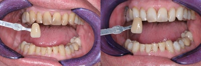 Whitening - 	This patient had severely darkened teeth and never thought he could do anything with them until we recommended KOR whitening. 2 weeks of take home whitening and then one 2 hour visit in the office and his teeth lighted 8 shades. He was very happy