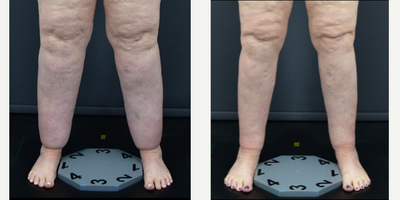 45-54 year old woman treated with Lipedema Surgery, Liposuction - Wonderful 1-year post-op results from lipedema circumferential liposuction surgery.