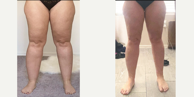 35-44 year old woman treated with Lipedema Surgery, Liposuction on thighs, calves and ankles - 1-year post-op results from circumferential lipedema liposuction surgery on the thighs, calves, and ankles.