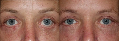 45-54 year old woman treated with Eyelid Retraction Repair - Lower lid retraction repair, mid face lift, canthoplasty, hard palate graft (hugely improved lower lid position)