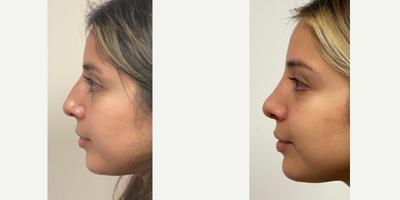 25-34 year old woman treated with Rhinoplasty - 1 year after a rhinoplasty