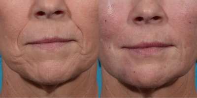 55-64 year old woman treated with Liquid Facelift - 1 Kit BellaFill to lower face