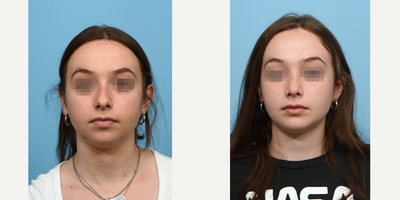 18-24 year old woman treated with Chin Implant - This patient underwent a combination rhinoplasty and chin augmentation surgery to improve her facial symmetry. 8 weeks post-op, she's thrilled with the outcome.