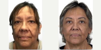 65-74 year old woman treated with Lip Lift, Lip Surgery, Lip Repositioning - Lip lift performed in combination with deep plane facelift and neck lift surgery to restore facial harmony and create elegant, natural rejuvenation. Notice the improvement in facial balance, horizontal thirds, upper tooth show, and the meticulously concealed lip lift scar.