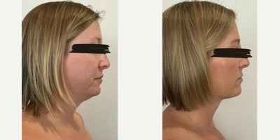 35-44 year old woman treated with Liposuction, Renuvion - FormSculpt liposuction of the double chin with Renuvion skin tightening. Notice teh improved angle of the neck and a more contoured jawline.