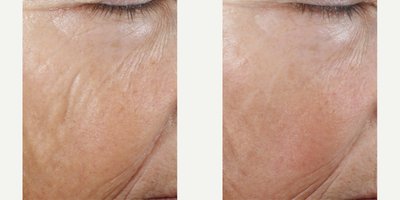Skinbetter Science - InterFuse Intensive Treatment Lines.Photo provided courtesy of Skinbetter Science.
