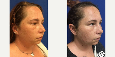25-34 year old woman treated with FaceTite - Patient was treated with Facetite with Morpheus8