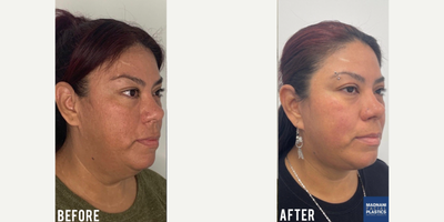 45-54 year old woman treated with Facelift - Deep Plane Facelift under local anesthesia