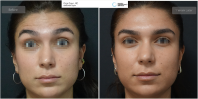 25-34 year old woman treated with Botox - Botox Treatment