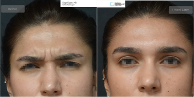 25-34 year old woman treated with Botox - Botox Treatment