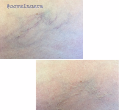 35-44 year old woman treated with Vein Treatment - Ohmic Thermolysis (VeinGogh) treatment of spider veins with immediate results.