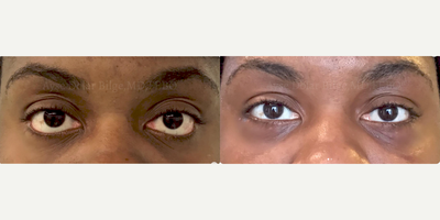 35-44 year old woman treated with Eyelid Retraction Repair - Ethnic lower eyelid retraction was repaired using spacer graft.