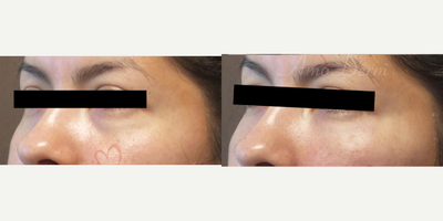 25-34 year old woman treated with Dermapen - 4D Under Eye Lift - Treatment of dark circles & bags under eyes and cheek restoration with Belotero, Restylane, Volbella and Voluma
