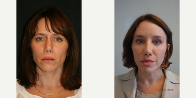 45-54 year old woman treated with Revision Rhinoplasty - This patient had multiple operations on her nose to correct the visual implications of a cleft lip-nasal deformity. In addition to Dr. Haworth performing his signature lip reshaping surgeries, he performed a very difficult revision rhinoplasty. Note the significant improvement in her nostril shape and at the alar base. The upper lip lift was performed at the same time it's a rhinoplasty. Understanding the vascular supply to the nose is paramount and when performing these two operations together which is frequently undertaken by Dr. Haworth.