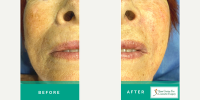 65-74 year old man treated with Silikon 1000 - This is a 70 year old lady interested in filler treatment to her nasal labial folds and Marionette Lines. Here she is after only her LEFT side has been treated. She elected to proceed with Silikon 1000 because of its results are PERMANENT! Can you see the difference between the treated and the untreated sides?