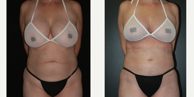 45-54 year old woman treated with Breast Fat Transfer, Liposuction, Breast Lift, Breast Implant Removal - -- Fat Transfer to Breasts. DONOR: Upper Abdomen & Hips.-- Anchor Breast Lift -- Implant removal