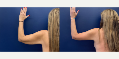 55-64 year old woman treated with Arm Lift - Brachioplasty