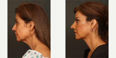 45-54 year old woman treated with Neck Lift, Brow Lift, Eyelid Surgery - performed by Dr.Sozer