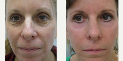 55-64 year old woman treated with Chemical Peel - Chemical peel to remove wrinkles especially under the eyes